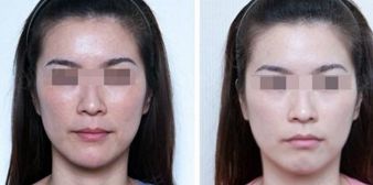 蚌埠哪家醫(yī)院擅長面部吸脂手術(shù)？蚌埠華美整形中心專業(yè)解答