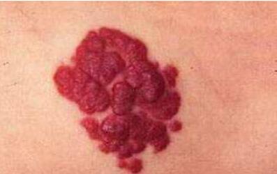 超聲炮能帶來(lái)哪些好處和壞處？它有何作用？