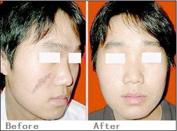 體驗(yàn)西安魔V面部鉆石微雕的魅力：權(quán)威整形醫(yī)院推薦