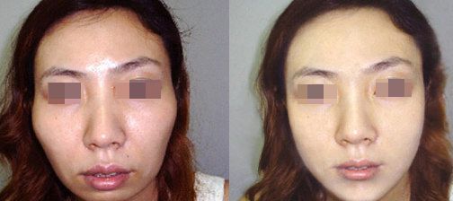 馮立哲多維拉面部提升效果持久？攻略揭秘！