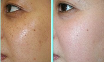 福州哪家醫(yī)院的激光嫩膚技術(shù)好？