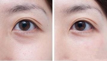 沈陽哪家醫(yī)院做雙眼皮效果好？