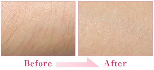 延吉雙眼皮埋線效果好的整形醫(yī)院推薦