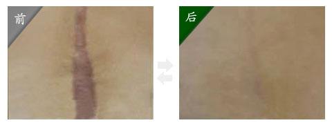 眼袋困擾怎么辦？9個(gè)小妙招竟然包括按摩、維E、茶葉、黃瓜、醫(yī)美？