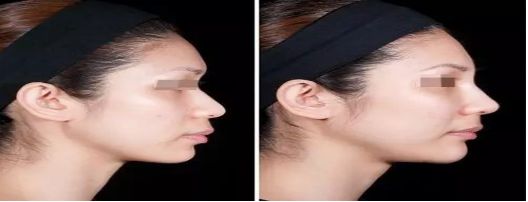 長沙小腿溶脂吸脂醫(yī)院口碑榜單：權(quán)威推薦