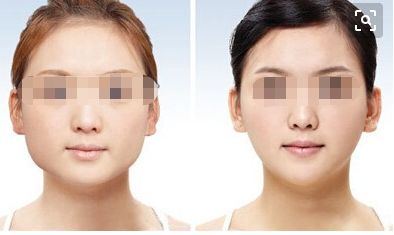 深圳懸吊提升術 口碑見證 締造年輕塑顏傳奇