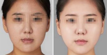 經(jīng)過治療前后鼻縮整形效果驚艷，絕美鼻型完美呈現(xiàn)！