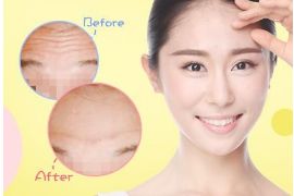 太原上瞼去脂術(shù)口碑佳，權(quán)威醫(yī)院解析排名推薦