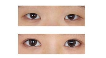 合肥假體隆鼻優(yōu)質(zhì)醫(yī)院大推薦，找專業(yè)醫(yī)生解答！