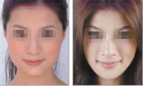 成都哪家整形醫(yī)院雙下巴去除效果好？排行前10強大揭秘