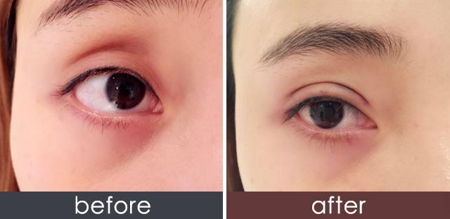 2023年上海很受好評的木偶紋射頻去除醫(yī)療美容醫(yī)院排名揭曉！