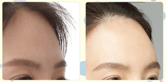 廣州痘痘治療哪家醫(yī)院效果最佳，口碑最好