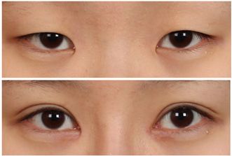 北京微針去痘印哪家好2023年最新北京微針去痘印排行榜