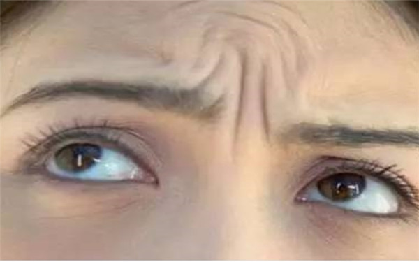 北京埋線雙眼皮修復(fù)術(shù)真的如此有效嗎？誰適合嘗試？