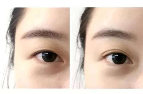 揭秘桂林自體填充眼底紋醫(yī)院10大高性價比選擇！2023最全攻略揭曉！