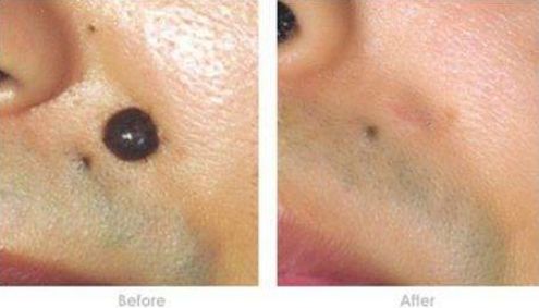 深圳哪家醫(yī)院做鼻子整形效果最好