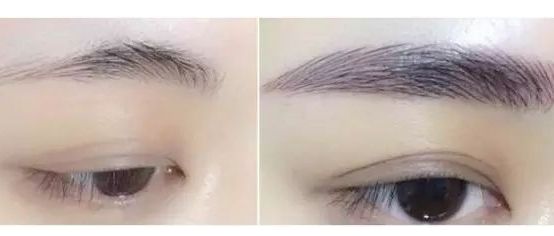 如何判斷一個(gè)人是否進(jìn)行了整容手術(shù) 通過(guò)鼻翼反光有何依據(jù)？