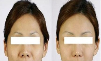 西安十佳小切口微創(chuàng)雙眼皮整形醫(yī)院榜單，專家評選