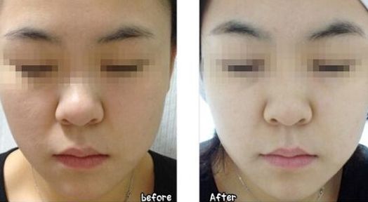 杭州十佳光電去魚尾紋醫(yī)院推薦