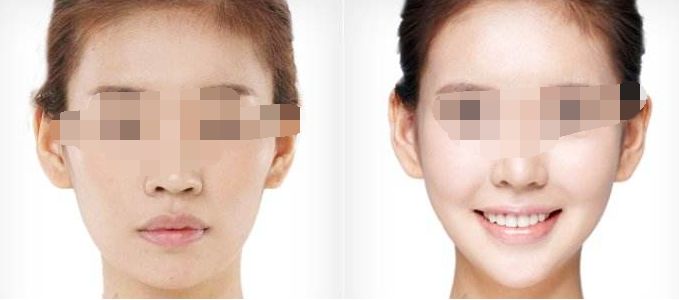 南昌哪家醫(yī)院的黃金微針整形效果好？2023年排名前十強(qiáng)盤點(diǎn)！