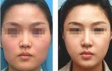 廊坊眼角去黃褐斑醫(yī)療整形專家推薦，10家正規(guī)醫(yī)院排名揭秘