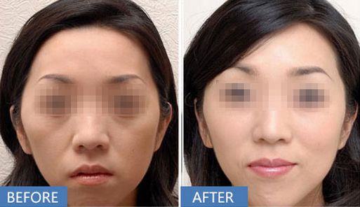 蘭州水楊酸祛黑頭：口碑前十強(qiáng)整形醫(yī)院指南