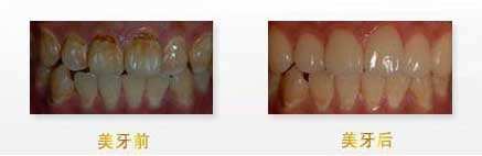 隆胸手術(shù)需要花費(fèi)多少錢？注意事項(xiàng)有哪些？