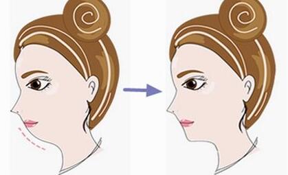 隆鼻術(shù)中自體軟骨隆鼻尖的平均價(jià)格是多少