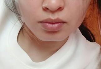 廣州美萊脂肪填充好嗎？如何選擇廣州美萊脂肪填充技術？