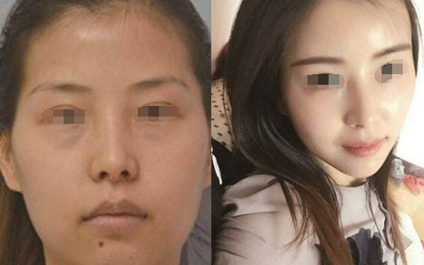 優(yōu)質(zhì)北海面部皺紋自體填充整形醫(yī)院推薦