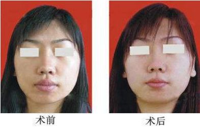 寧波水光針整形美容醫(yī)院哪家好？前十榜單全公開！