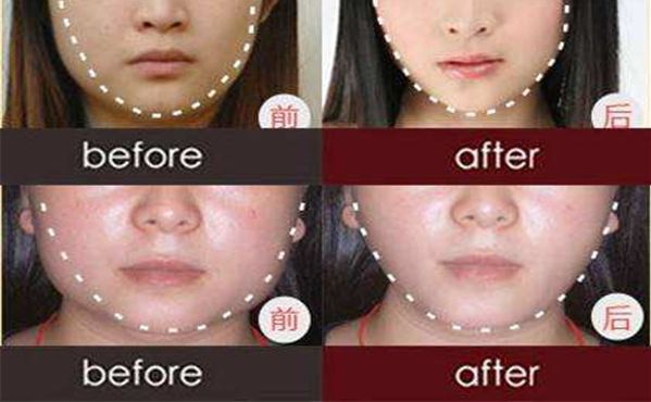 杭州面部全臉填充哪家醫(yī)院好？盤點杭州十佳美容醫(yī)院