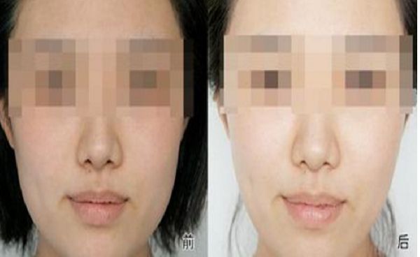 安徽皮秒祛印第安紋：10家權(quán)威整形醫(yī)院深度測評