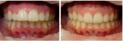 漳州脈沖光祛痘印哪家好？看這篇就夠了！