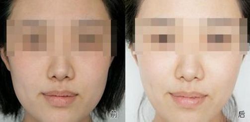 大拉皮去皺醫(yī)院 北京前十強(qiáng) 2024 年更新