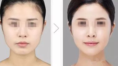 廈門哪家醫(yī)院做自體脂肪豐臉部整形效果好？Top10強(qiáng)醫(yī)院揭秘