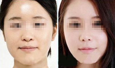 揚州小切口祛眼底紋醫(yī)院推薦指南