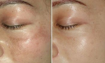 【2023蘭州哪家醫(yī)院鼻子整形效果好？專(zhuān)家推薦+真實(shí)患者案例】