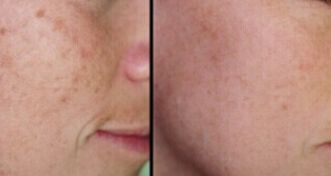 石家莊去痘坑的醫(yī)院排名與口碑調(diào)查，哪家醫(yī)院好？