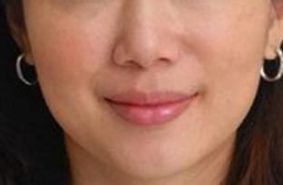 醫(yī)療整形2023年開(kāi)封十強(qiáng)腰部溶脂針注射醫(yī)院推薦