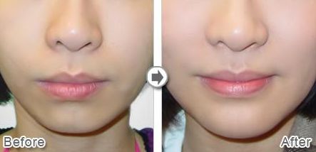 合肥哪家醫(yī)院臀部吸脂好？臀部吸脂手術(shù)哪家醫(yī)院技術(shù)高超，效果明顯？