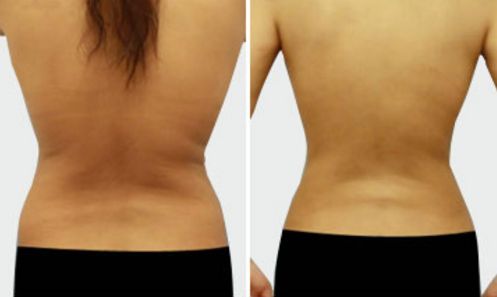 上海哪家整形醫(yī)院專業(yè)祛眼袋效果好？