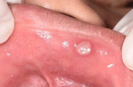 北京填充玻尿酸，選擇哪家醫(yī)院最靠譜？