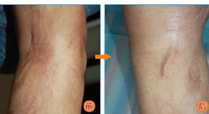 30歲肌膚還能用BOTOX除皺果嗎？