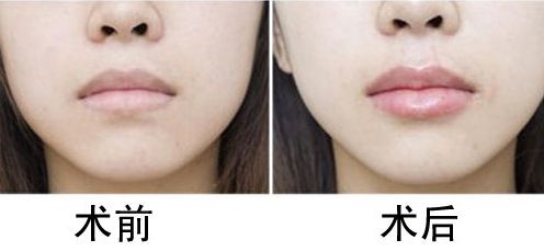 杭州雙眼皮效果好的醫(yī)院有哪些？