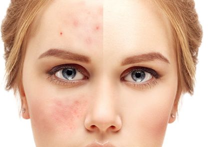 新疆祛痘印醫(yī)院排名及口碑哪家好？