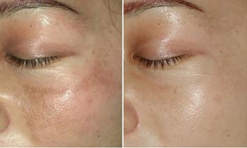 深圳南山牙齒矯正哪家醫(yī)院效果好？