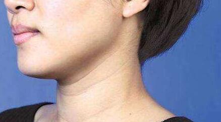 換膚果芯絲翠果酸有效改善肌膚問(wèn)題嗎？