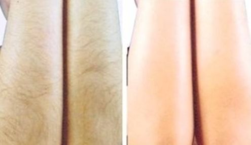 昆明哪家醫(yī)院專業(yè)治療雀斑效果好？