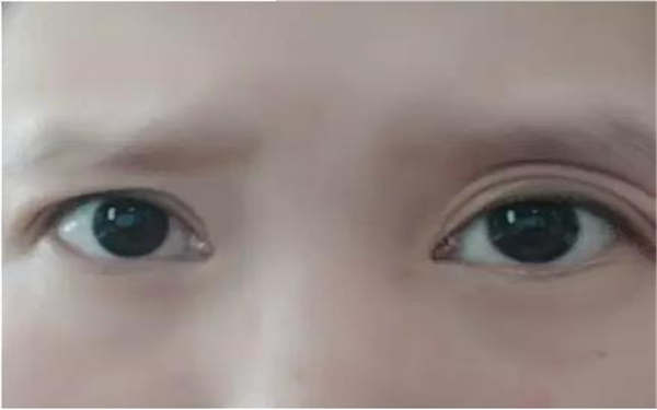 注射瘦臉會有哪些副作用？購前必看！